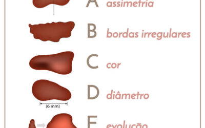 ABCDE DO MELANOMA